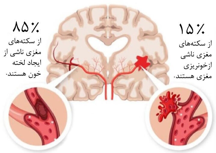 لخته خون در سکته مغزی لخته خون در سکته مغزی